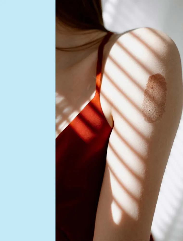 Birthmark Reduction
