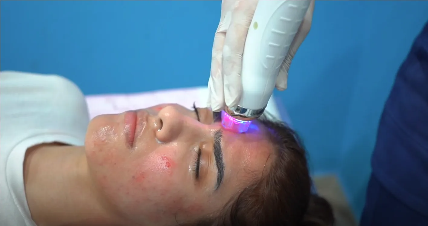 Zarnab Javed’s Microneedling RF Review