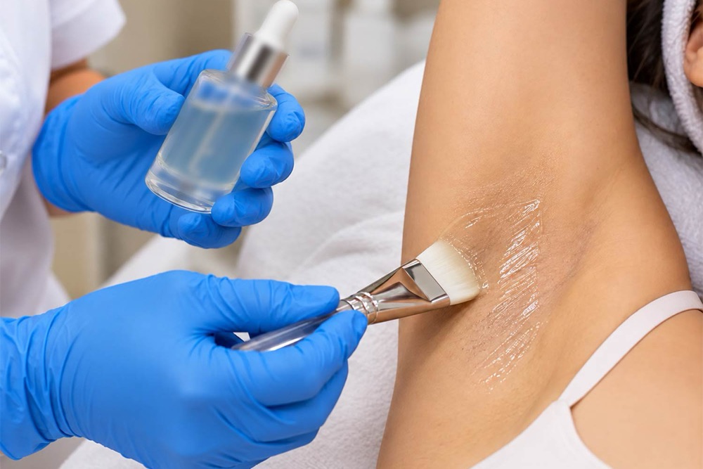 Dark underarms treatment: a glycolic peel brushed onto the underarm