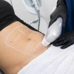 Ultraformer body HIFU