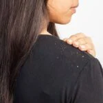 Keravive scalp HydraFacial