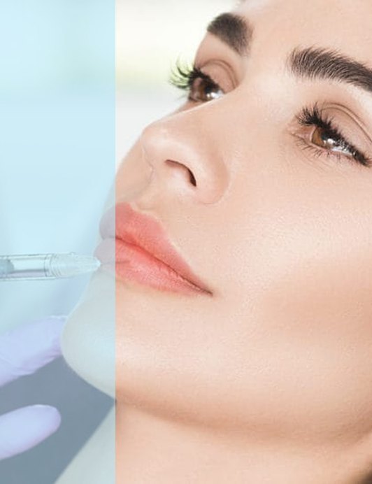 Lip Fillers