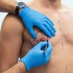 Gynecomastia (man boobs)