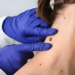 Mole removal