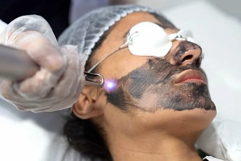 Pico laser for acne scars: the picosecond laser passes over a carbon mask on a man's cheek