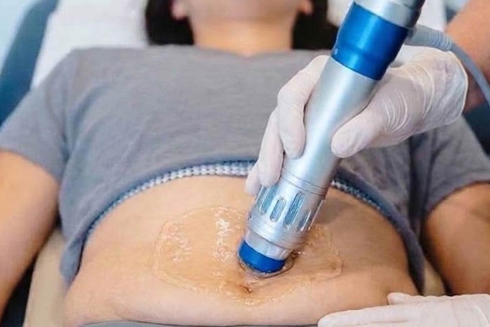 Shock wave therapy on the tummy: the shock wave handpiece pressed onto gel on the skin