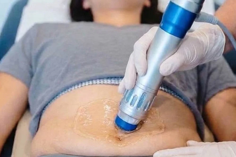 Shock wave therapy on the tummy: the shock wave handpiece pressed onto gel on the skin