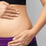 Stretch marks treatment