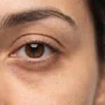Under-eye fillers