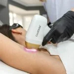 Underarm laser hair removal