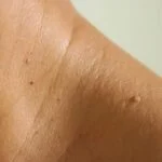 Wart removal